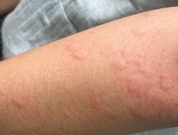 Biduran dan Penyebabnya, Apa Saja yah Paling Dominan?