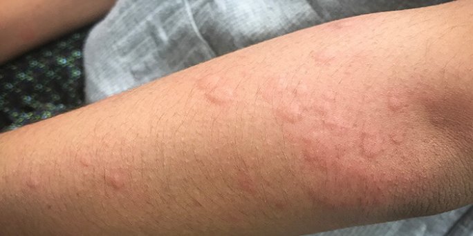 Biduran dan Penyebabnya. Kira-kira ada apa saja?