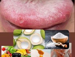 Cara Mengobati Sariawan di Lidah, Dijamin Ampuh